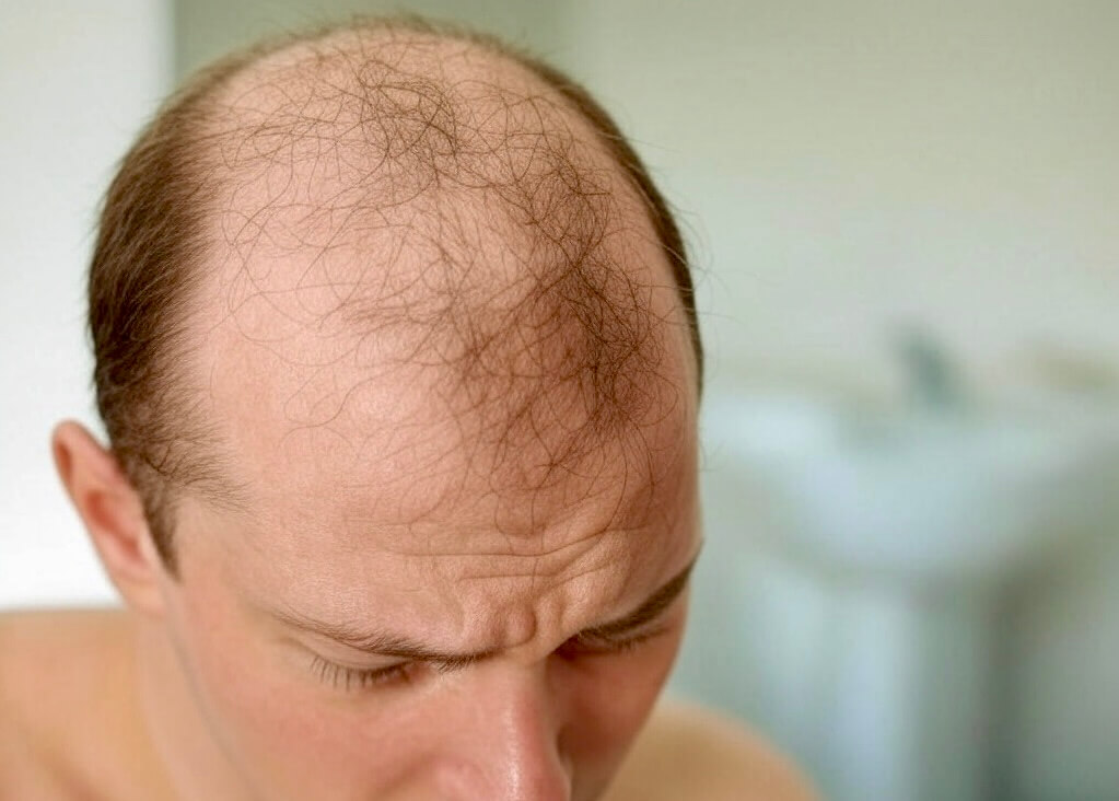 علاج تساقط الشعر باستخدام الضوء الأحمر