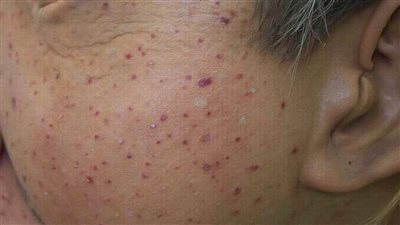 الصحة تستنفر في المطارات والموانئ لمنع تسلل فيروس M Pox.. إجراءات مشددة على الحدود