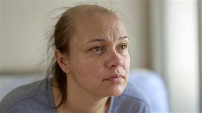 مينوكسيديل لعلاج تساقط الشعر: كيف يعمل؟ ومن يناسبه؟ نصائح للاستخدام الأمثل لتحقيق النتائج المثالية والحد من الآثار الجانبية